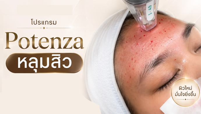 โปรแกรม Potenza หลุมสิว รูขุมขน กระชับผิวหย่อน ลดริ้วรอยเล็กๆ พร้อมได้งานผิวสวยในครั้งเดียว